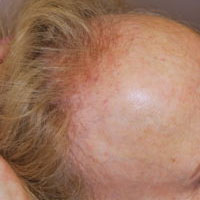 scarring alopecia