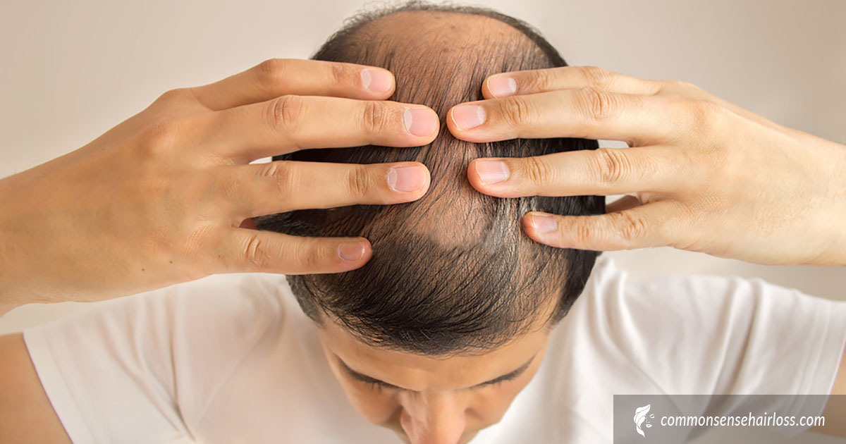 Scalp Exercises For Hair Loss