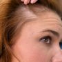 Can Hair Color Cause Hair Loss?